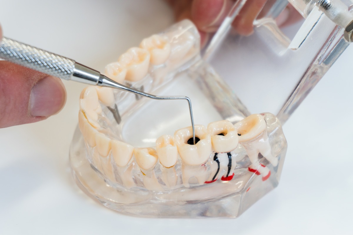 Root Canal Therapy – Alfredton Dental